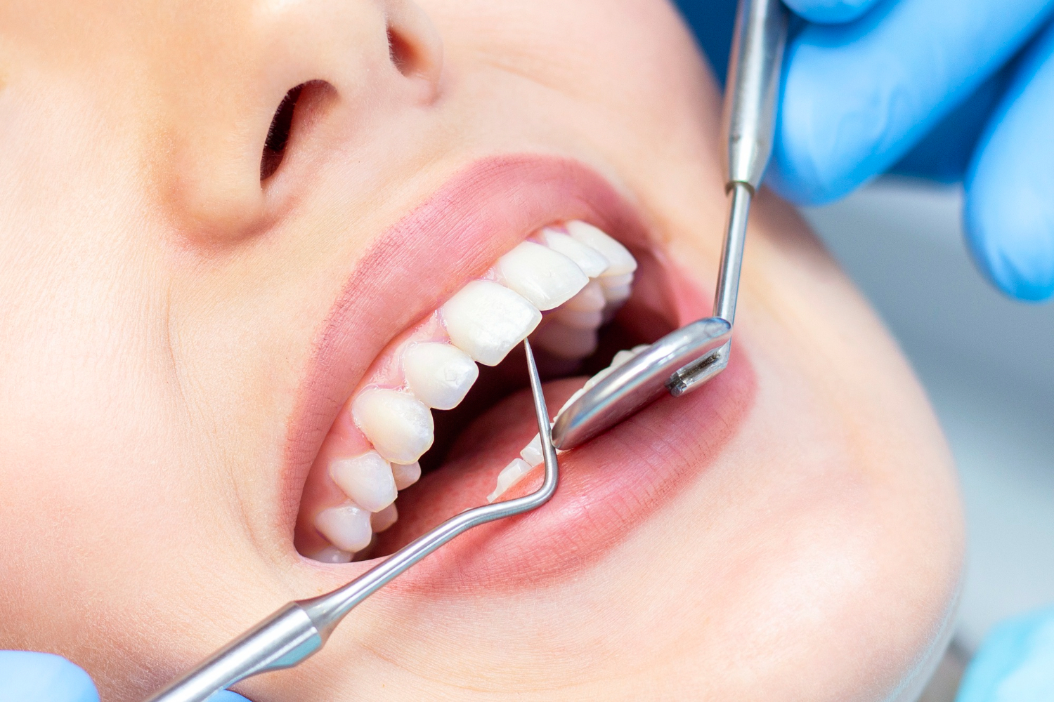 Prophylaxe, Professionelle Zahnreinigung (Mundhygiene)